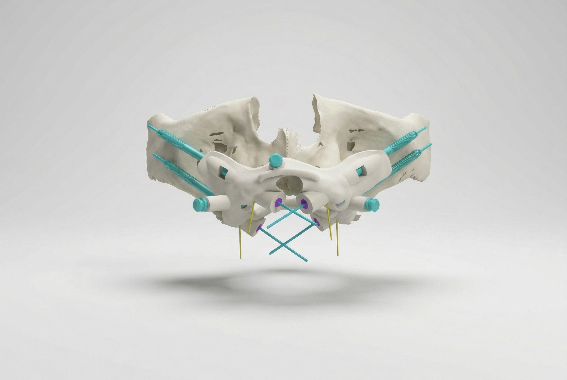 Zygomatic Surgical Guide